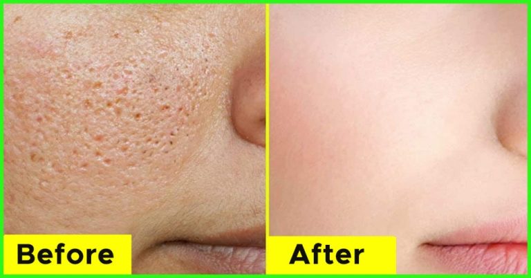 Home Remedies To Get Rid Of Open Pores On Skin Permanently 1024x536 1 768x402 1